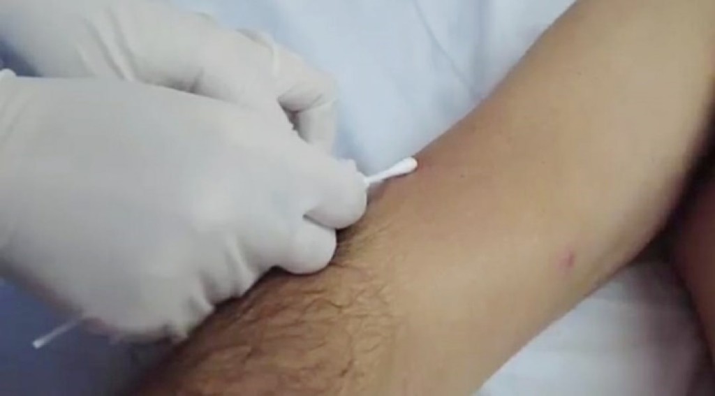 Goiás realiza "Oficina Monkeypox" para profissionais de saúde