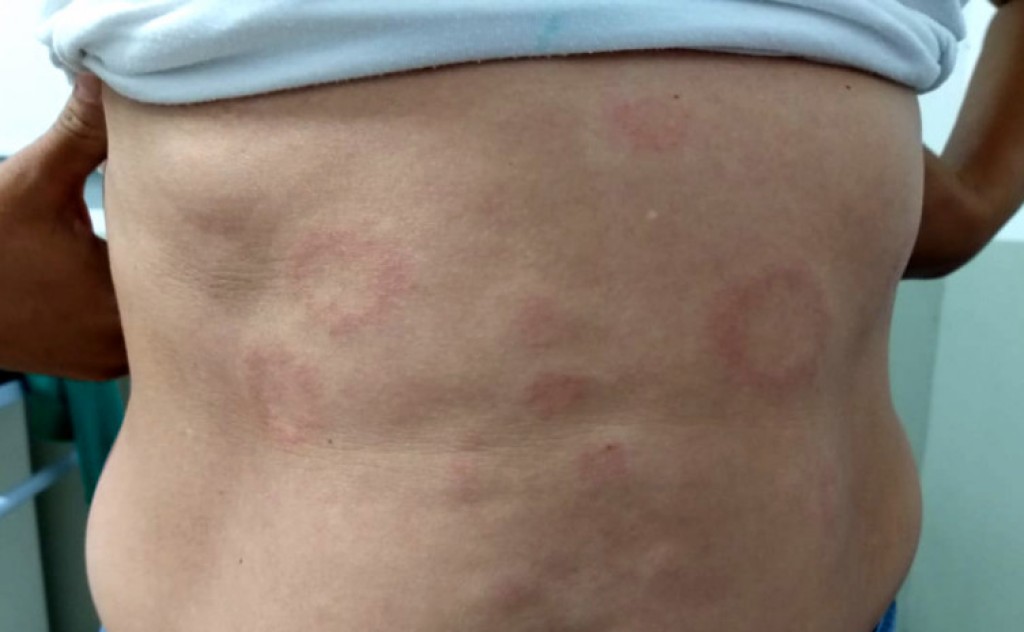 Saúde alerta para incapacidades provocadas pela hanseníase