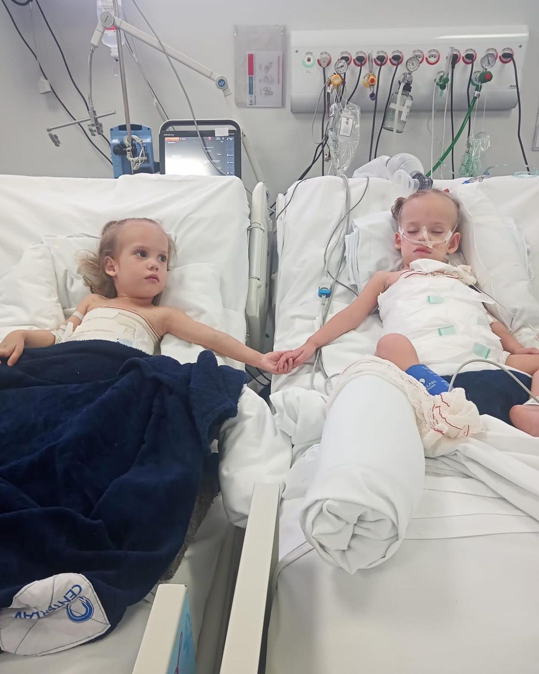 Siamesas separadas em Goiânia, recebem alta da UTI