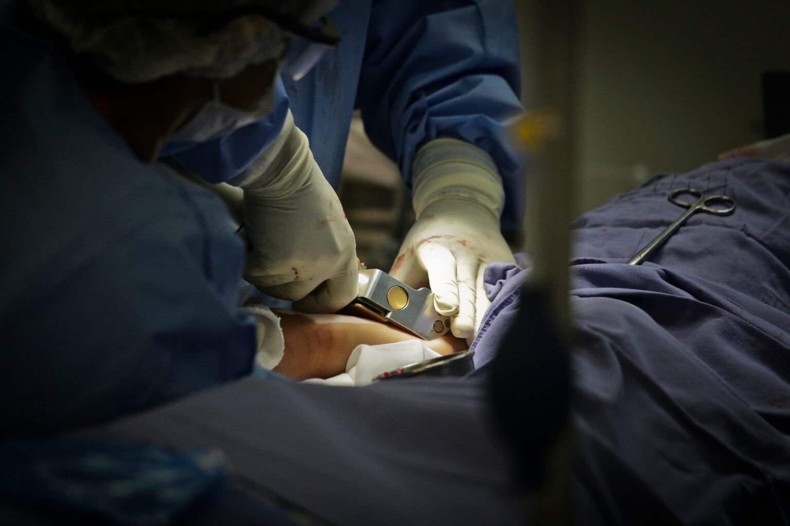 Hospital Regional realizará transplantes de pele