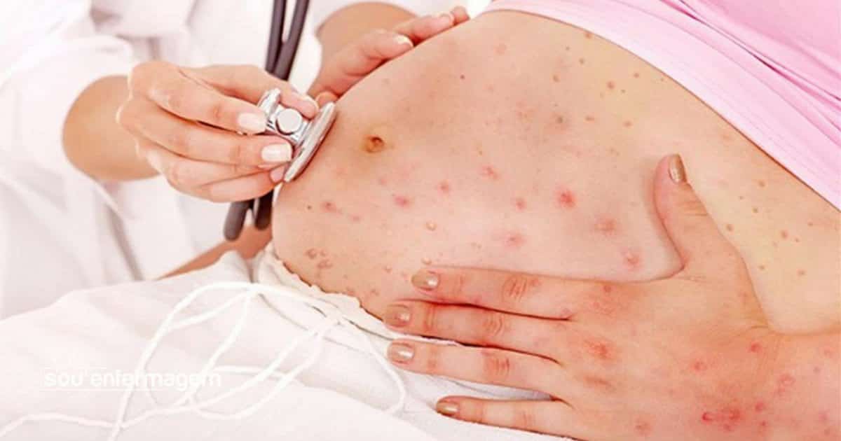 Saúde equipa unidades para monitoramento da sífilis em Goiás